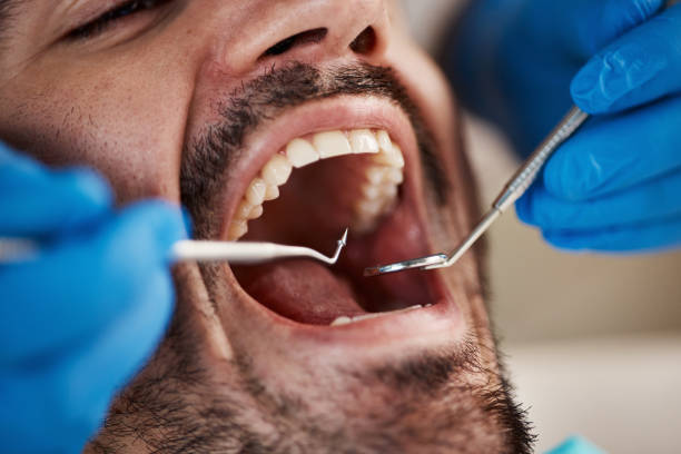 Best Emergency Wisdom Teeth Removal in Nowata, OK